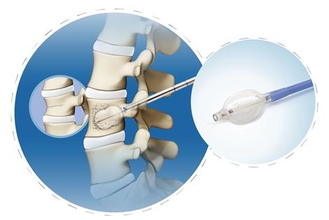【金沙平台注册】椎体扩张球囊导管(PKP)